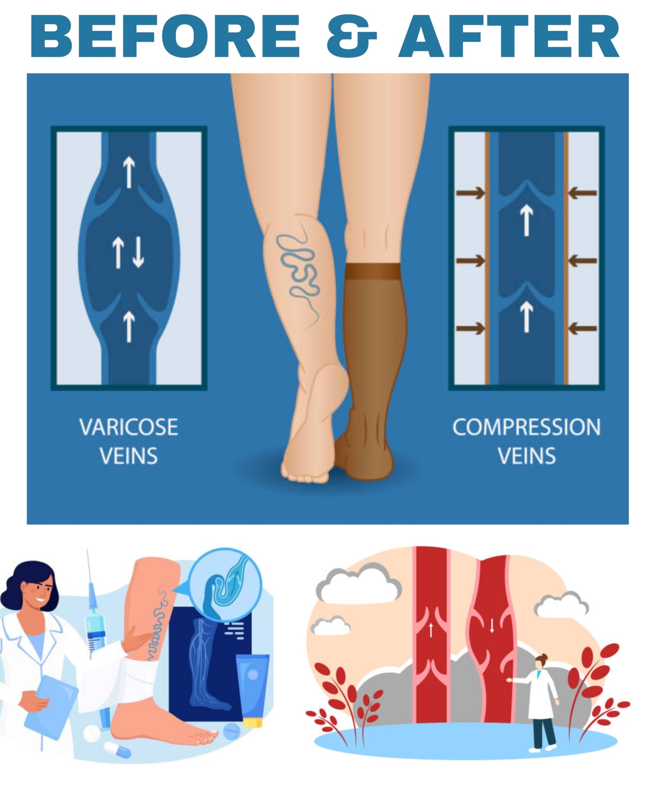 Before and after comparison graphic for varicose veins, showing a leg with twisted varicose veins on the left and a leg with compressed veins on the right, plus small medical illustration panels at the bottom.